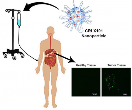 The nanoparticle therapeutic CRLX101 (schematic illustration provided by Cerulean Pharma Inc.) was given intravenously to patients with stomach cancer. Biopsies were taken of both the stomach tumor and nearby, healthy tissue. Evidence of the nanoparticle delivered drug (bright green dots) was seen only in the tumors of the nine patients investigated, and not in their adjacent healthy tissue. Credit: Courtesy of the M. E. Davis Laboratory/Caltech